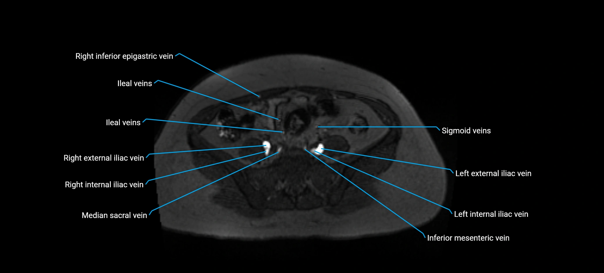 MRV abdomen pelvis & lower limb axial cross sectional anatomy labelled MRI image 132 (1).webp